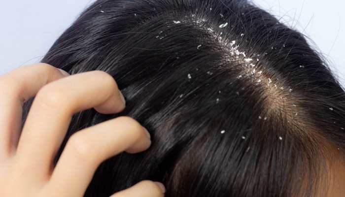 هل هناك ما يُعرف بـ طريقة إزالة القشرة من الشعر نهائيا!